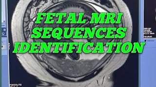 MRI FETAL SEQUENCES WITH INDENTIFATION FETAL MRI SEQUENCES [upl. by Elleivad]