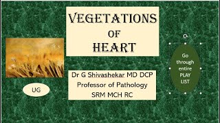 VEGETATIONS OF HEART  Pathology  RATS  MBBS SRM  Dr GSS  University Exam Chart [upl. by Aryajay]