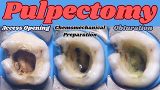 Pulpectomy ⚪️ PRIMARY MAXILLARY MOLAR 🟡 4 Canals 🔵 step by step demonstration [upl. by Artina]