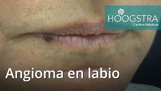 Angioma en labio 16135 [upl. by Amis]