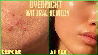 HOW TO GET RID OF ACNE PIMPLES BUMPS ON FACE OVERNIGHT  Simple Home Remedy DIY Lemon Treatment [upl. by Lenoj]