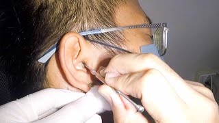 Mans HUGE Earwax Removal  Hes Deaf No More [upl. by Oskar692]