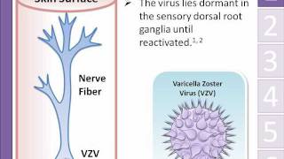 Shingles herpes zoster Animation  Michael Freudiger [upl. by Anemolihp]