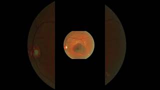 Are supplements beneficial for macular degeneration [upl. by Biamonte]