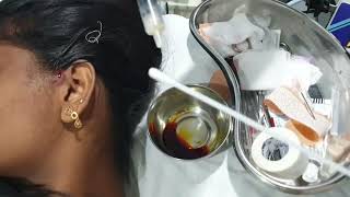 Preauricular sinus abscess aspiration Patient teaching programme Hindi [upl. by Eittik]