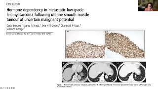 LMSDR Webinar Role of Estrogen Suppression in Uterine Leiomyosarcoma [upl. by Kirsten]