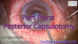 Pars Plana Posterior Capsulotomy DR SUDHIR SRIVASTAVA [upl. by Neelav]