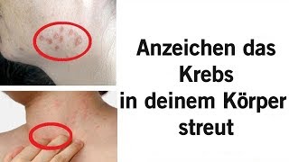 7 Frühe Warnzeichen und Symptome von Krebs die die meisten Menschen nicht kennen [upl. by Arimlede492]