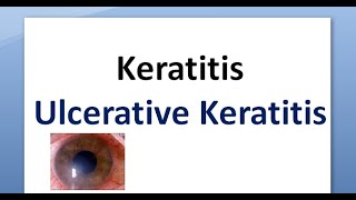 Ophthalmology 110 a Keratitis Cornea Inflammation Corneal Ulcer Ulcerative Ulceration [upl. by Duthie65]