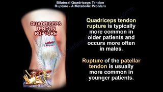 Bilateral Quadriceps Tendon Rupture  Everything You Need To Know  Dr Nabil Ebraheim [upl. by Drusus]