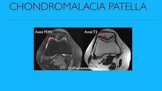 Chondromalacia patella MR features and classification [upl. by Naitsirt]