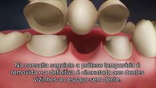 Ponte substituindo um dente perdido Prótese Fixa sobre dentes [upl. by Enirhtak]