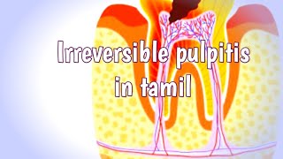 Irreversible pulpitis in tamilpulpitisflowerpot1564 [upl. by Aicilet148]