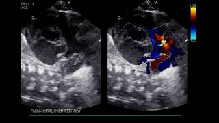 PATENT DUCTUS ARTERIOSUS LEFT HEART DILATION [upl. by Kirkwood]