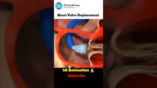 Heart Valve Replacement Procedure 👨‍⚕️ [upl. by Ahseei]