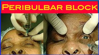 how to perform ideal Peribulbar anaesthesia in eye surgery [upl. by Fulcher]