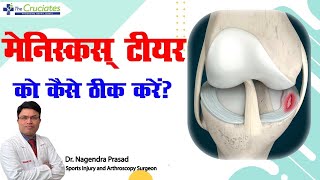 मेनिस्कस् टीयर बिना सर्जरी के ठीक करे  Treat Meniscus without surgery  मेनिस्कस् टीयर की सही इलाज़ [upl. by Eirised]