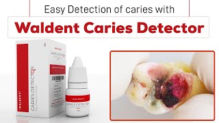 Easy Detection of Caries with Waldent Caries Detector [upl. by Luisa]