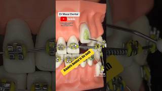 Glue the ortho bracket on the tooth [upl. by Phylys]