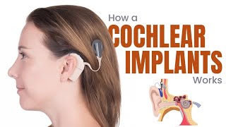 Cochlear Implants What are they and How do they work  3D Guide [upl. by Haven]