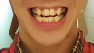 Apparecchio invisibile Invisalign A Bari Studio dentistico Specializzato [upl. by Ardnuhsor]