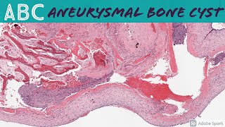 Aneurysmal Bone Cyst ABC 5Minute Pathology Pearls [upl. by Harv677]