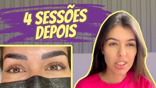 DESPIGMENTAÇÃO DE SOBRANCELHA MINHA EXPERIÊNCIA  ANTES E DEPOIS [upl. by Lihas626]