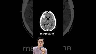 TUMOR TIPO MENINGIOMA  IMAGEN medicina radiologia doctor neurología neurocirurgia [upl. by Kieffer574]