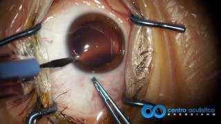 Phakic IOL  ICL Staar Visian Implantation Technique [upl. by Schaper948]