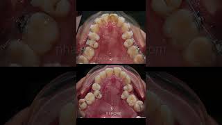 Braces process  Straighten teeth [upl. by Samuela447]