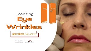 Eye Wrinkle Removal with Belotero Filler  Skin Perfect Los Angeles Area [upl. by Tyra805]