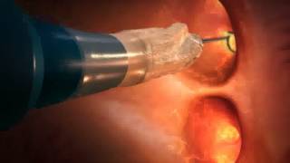 How Cryoballoon ablation works [upl. by Lletnohs]