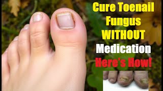 Toenail Fungus Cured Naturally Here’s the Secret [upl. by Lallage]