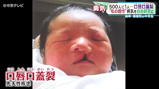 【“私の個性”病気を自由研究に】500人に１人の割合の病気「口唇口蓋裂こうしんこうがいれつ」 岐阜・御嵩町の中学生 [upl. by Kerad]