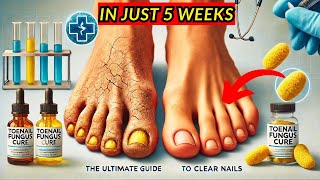 Toenail Fungus Cure The Ultimate Guide to Clear Nails [upl. by Eniaj139]