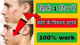 सिर्फ 1 दिन में चेहरे के पिम्पल्स हटाये 100 work chehre par pimples kese hataye [upl. by Grantland]