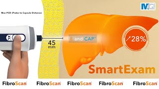 MediGroup I SmartExam  Continuous CAP™  Nâng cao giá trị của FibroScan® [upl. by Ennaid306]