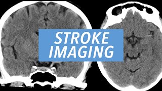 Imaging Findings of the Acute Ischemic Stroke CT CTA and MRI Brain Exams Reviewed [upl. by Alaikim726]