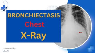 Bronchiectasis X Ray Bronchiectasis Chest X Ray Findings [upl. by Jempty813]