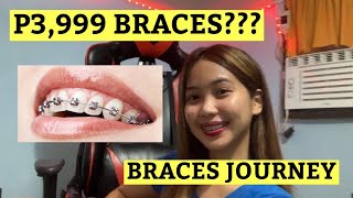 MAGKANO BA ANG MAG PA BRACES experiences  requirements 2021 [upl. by Akemehc483]