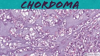 Chordoma 5Minute Pathology Pearls [upl. by Aneekan41]