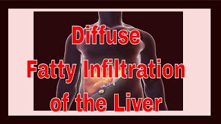 Diffuse Fatty Infiltration of the Liver [upl. by Rambort464]