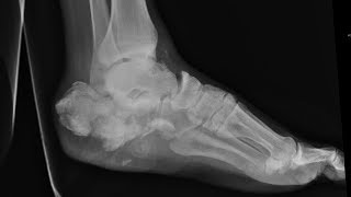 How to manage swelling amp pain post calcaneous fracture in young men of 20s Dr Mohan M R [upl. by Ahseikal]