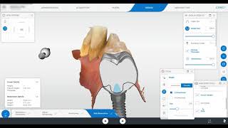 Cerec Implant Crown Design [upl. by Philipps]