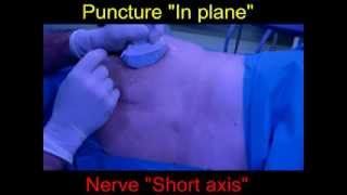 Ultrasound Sciatic Nerve Blockade Casals Approach part1 [upl. by Babbette724]