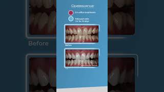 Opalescence™ Boost™ and Opalescence™ PF  Case Study [upl. by Letniuq485]