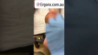 Cracked heels callus hard skin removal by podiatrist [upl. by Stefano]