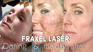 My FRACTIONAL CO2 LASER Experience  The FULL Treatment amp the DAYS following  BEFORE amp AFTER Fraxel [upl. by Trix]