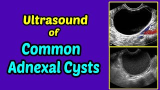 Ultrasound of Common Adnexal Cysts [upl. by Wiese]