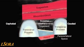 LSORA paravertebral block US guided tutorial [upl. by Bradlee]